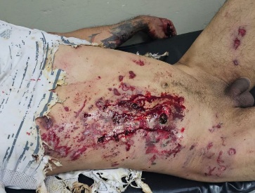 Victime of Artificial bomb explosion 