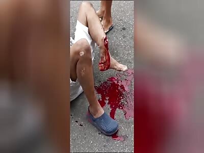 The man has a serious leg injury in an accident