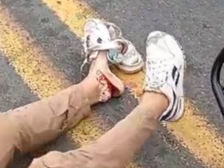 Horrible leg injury after motorcycle crashed by truck 