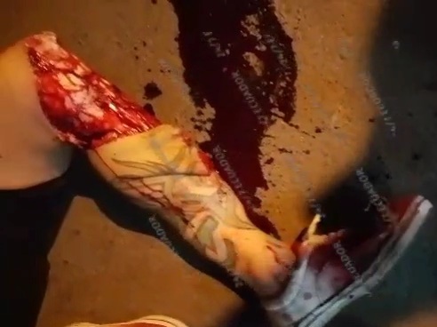 Horrific leg injury due to motorcycle crash 