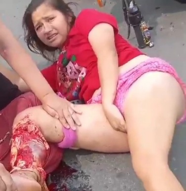 Young woman horrifically crashed her leg due to motorcycle accident 