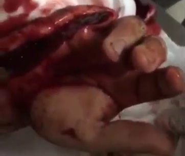 Horrific machete wound 