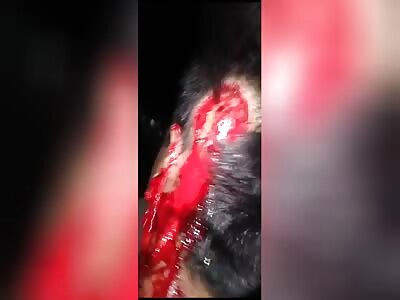 severe scalp injury machete attack