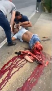 Both legs Crushed when Jumping from a Moving Truck