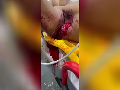 Young Brazilian man. Killed by lightning.