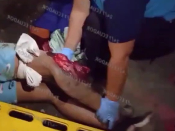 Horrific leg injury of female motorcyclist 