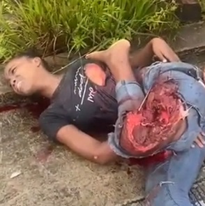 Young Woman Moans In Pain Suffering Nasty Leg Injury