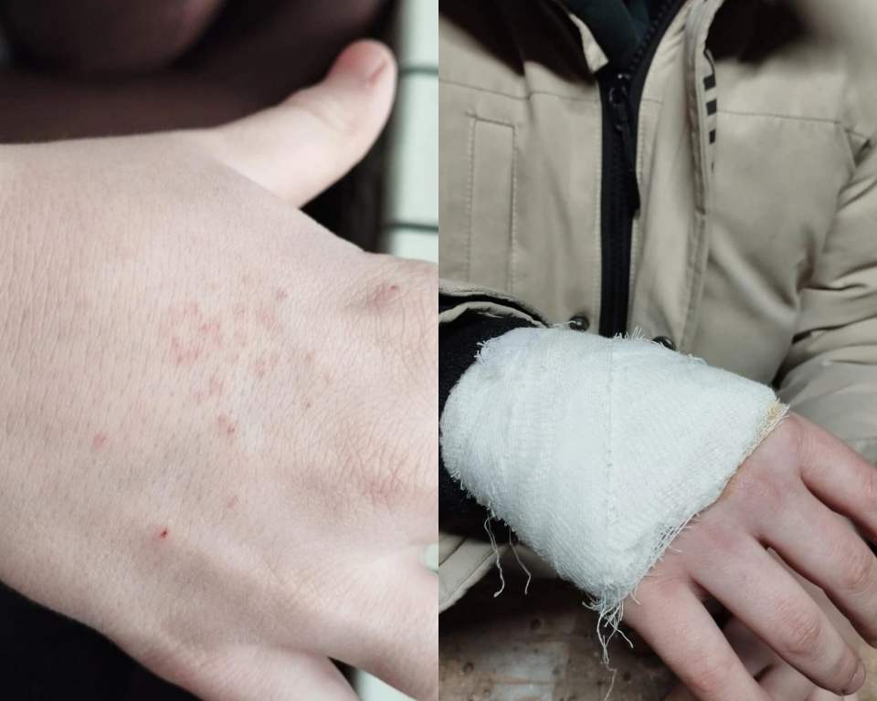 Teacher Pricks Schoolboy 27 Times With Compasses