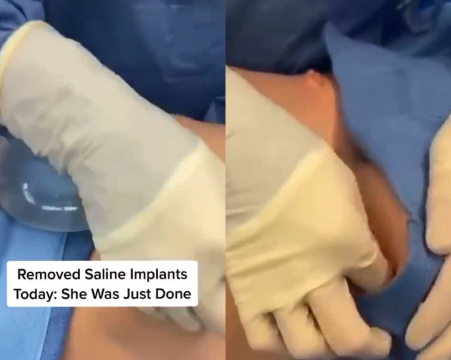 Removal Of 2 Breast Implants Using Saline Solution
