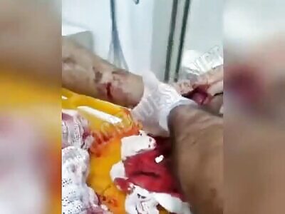 Adjusting the foot without anesthesia