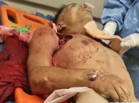 Motorcyclist badly wounded after a brutal crash 