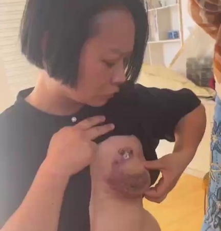 Breast augmentation gone wrong [maybe a cancer]