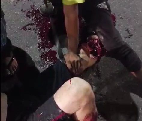 Horrific leg injury after brutal motorcycle accident 