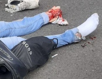 Horrible leg injury after motorcycle accident 