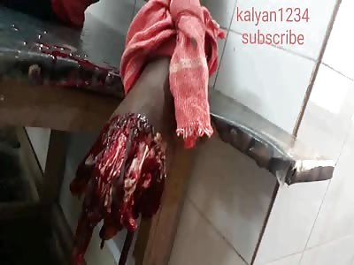 Sugarcane Juice Machine Accident (Aftermath)