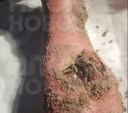 Russian wounded soldier with infected leg full of worms 