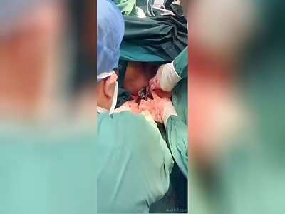 Anus Surgery went WRONG