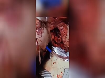 Woman Left With Gaping Wound