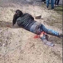 Truck Crushed Her Leg