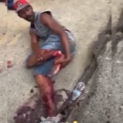 Man In Shock Tries To Reattach His Severed Foot