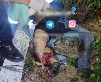 Horrific motorcycle accident leave young man with shattred body 