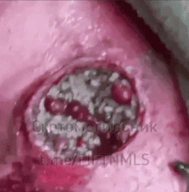 Ukrainian man alive with parasites in his wounds.