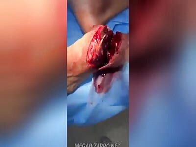 Man suffers foot amputation in brush cutter accident 