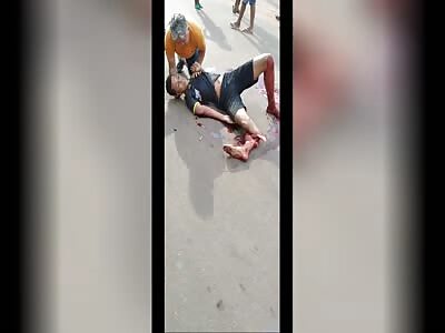 Accident Victim With Serious Fracture