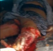 lady and her legs crushed on the bus