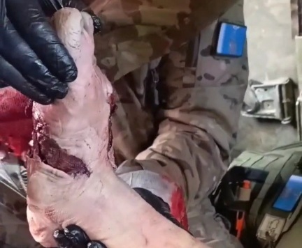 Russian soldier shattred leg due to landmine 