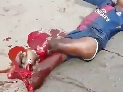 Teen's Legs Got Mangled