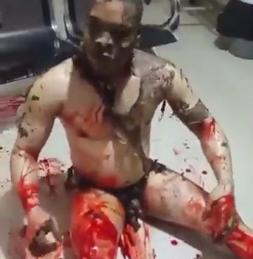 many victims suffering different degrees of burnt after a gaz explosio