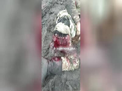 Chechen Soldier Lost his Leg in Kursk