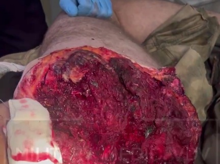 Losing your Ass on the Battlefield.