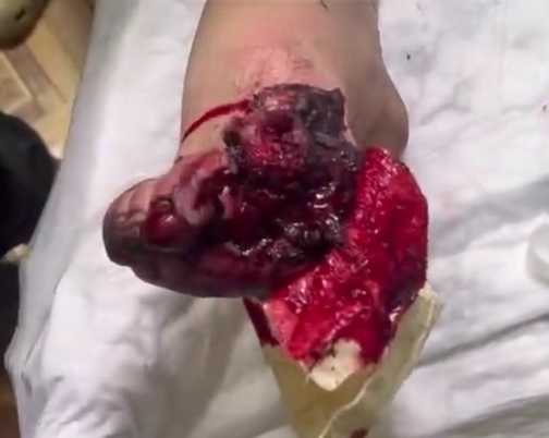 Russian wounded soldier after stepping on a landmine 