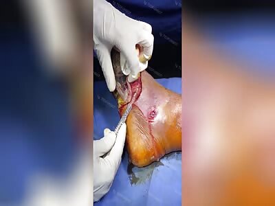 diabetic had his rotten leg cut off