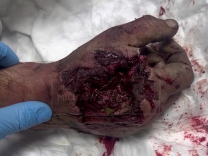 Russian wounded soldier hospitalized 