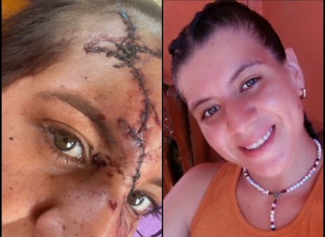 [FIGHT+AFTERMATH]woman gets her face sliced with broken bottle 