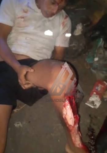 Biker Fainted When He Saw His Exposed Bones