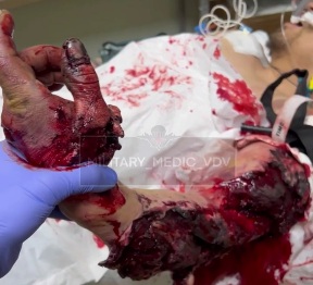 [HORRIFIC FOOTAGE]Russian wounded soldier hospitalized 