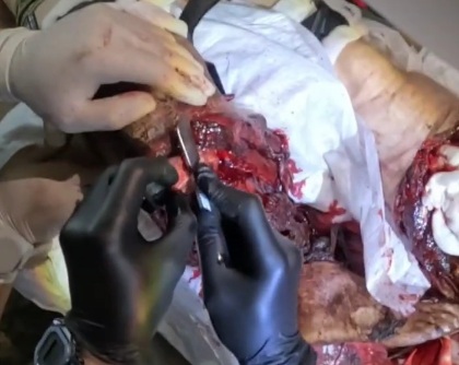 [HORRIBLE SOUND]Russian wounded soldier get his shattred legs amputed 