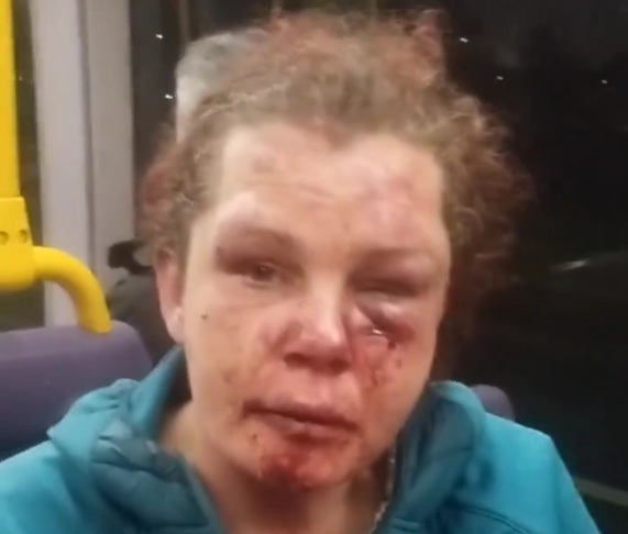 Dublin woman gets the shit kicked out of her by her alcoholic partner 