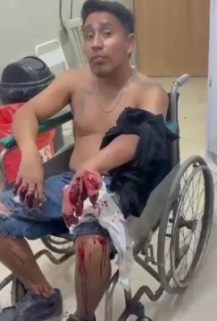 victim's hand blown off by fireworks