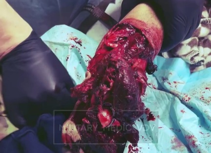 Russian soldier with shattred leg after stepping on a landmine 