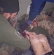 DAMN: A Battlefield Amputation