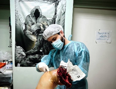 Leg Amputation from Land Mine! 