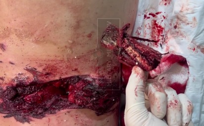 Russian wounded soldier hospitalized 