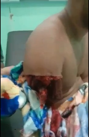 man had arm ripped off in accident