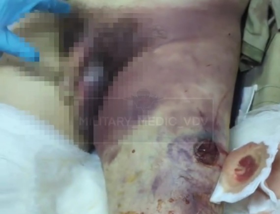 Russian wounded soldier hospitalized 