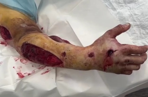 Wounded Russian soldier hospitalized 